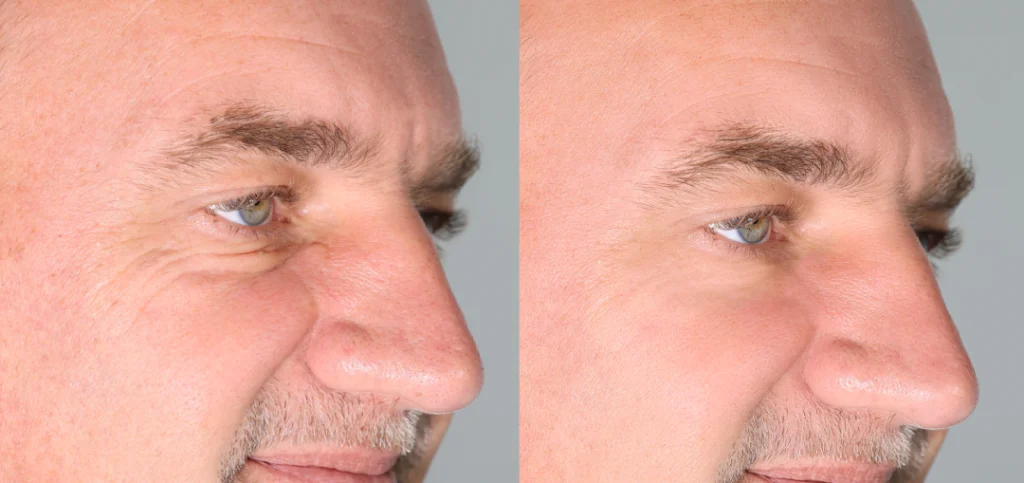 A before-and-after comparison showcasing the rejuvenating effects of Sculptra.