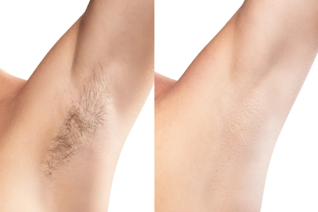 Before and after laser hair removal on underarm.