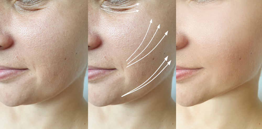 Before and after results of skin tightening with PDO threads.