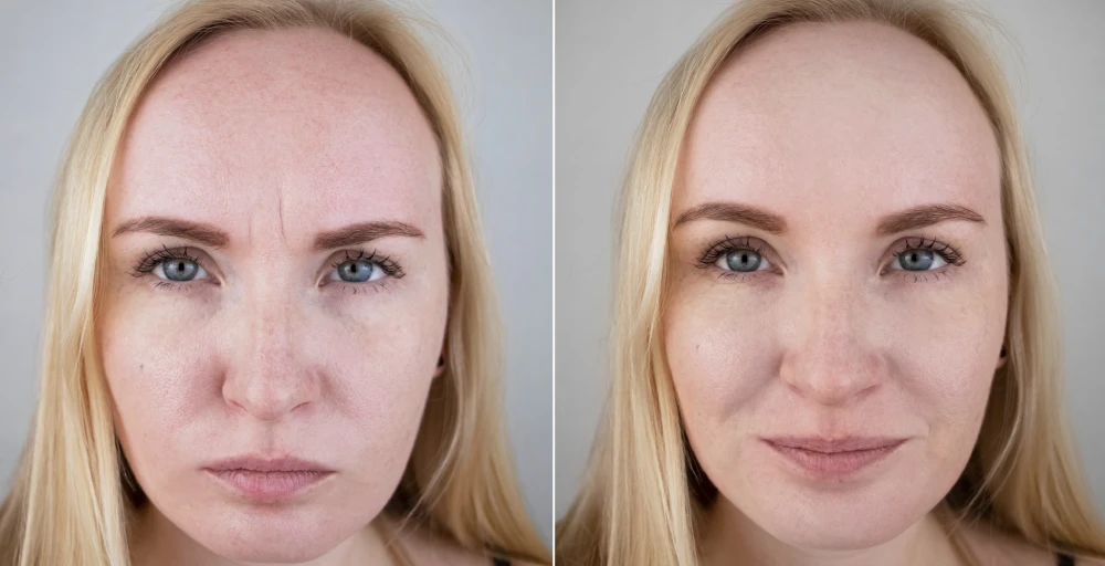 Daxxify before and after results for neck lines