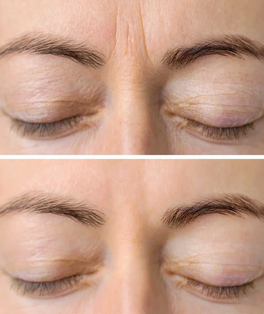 Xeomin before and after results showing wrinkle reduction