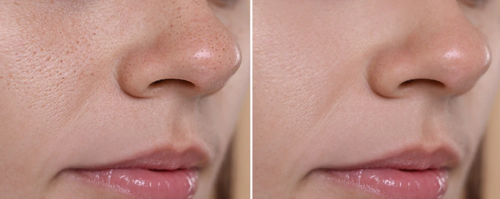 Before and after DiamondGlow facial results on pores and skin texture.