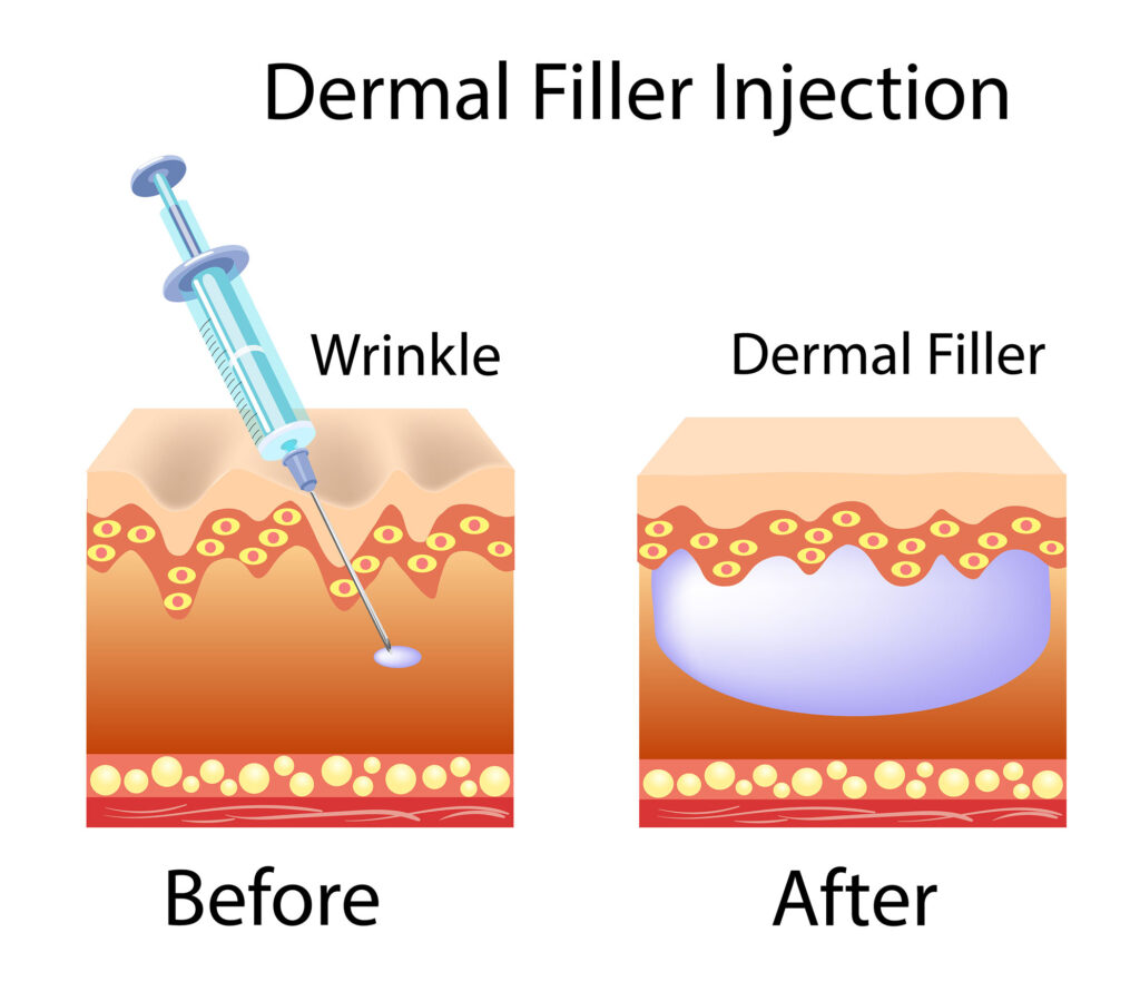 medical diagram showing a syringe injecting filler under the skin next to a labeled before and after comparison