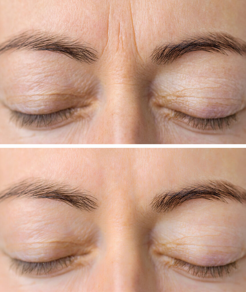 Before and after neuromodulator treatment on forehead wrinkles.