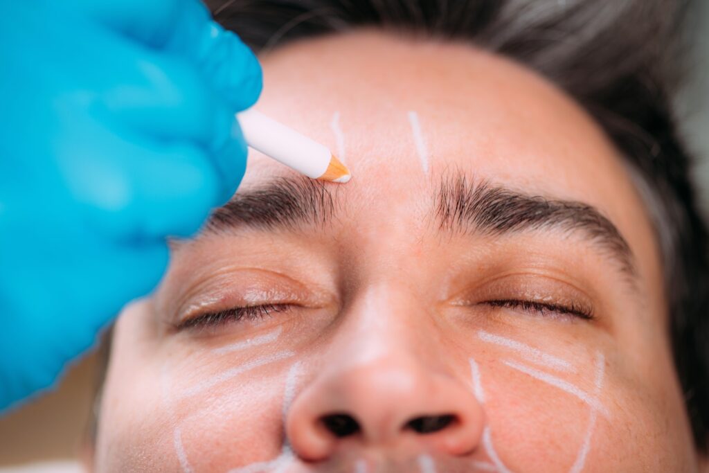 Close-up of a person’s forehead as a gloved hand uses a white pencil to mark lines above the eyebrows.