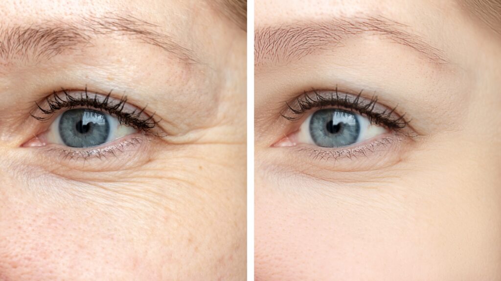 Side-by-side close-up views of a person’s eye and surrounding skin, shown from the same angle.