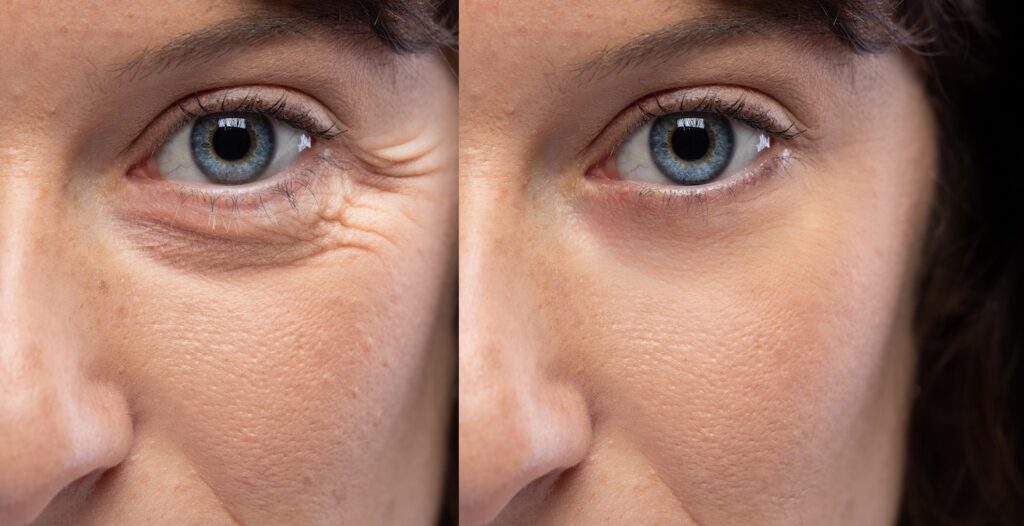Side-by-side close-up views of a person’s eye and under-eye area, showing the same eye from two similar angles.