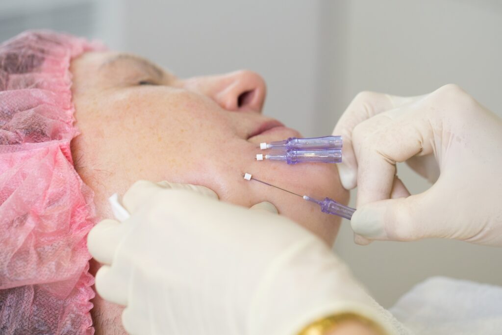 Close-up of a person lying down while gloved hands insert thin needles into the chin area.