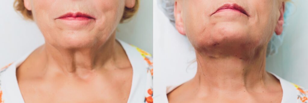 Side-by-side close-up views of a person’s lower face, chin, and neck shown from the front and slightly tilted upward.