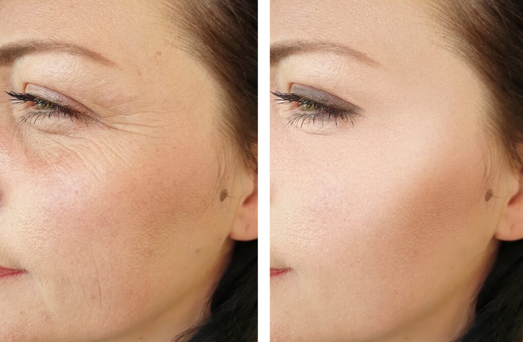 Side-by-side close-up of eye area showing visible fine lines on left and smoother skin on right.