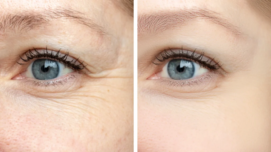 Close-up of eye area before and after showing reduced fine lines