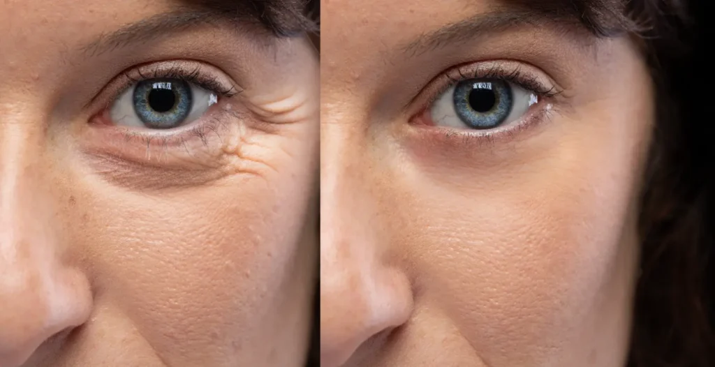 Side-by-side close-up comparison showing visible differences in under-eye lines and texture
