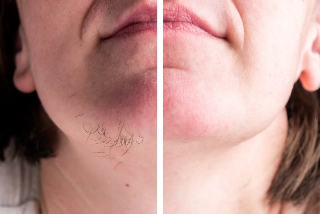 Left and right close-up images show the chin before and after facial hair removal with visible hair differences.