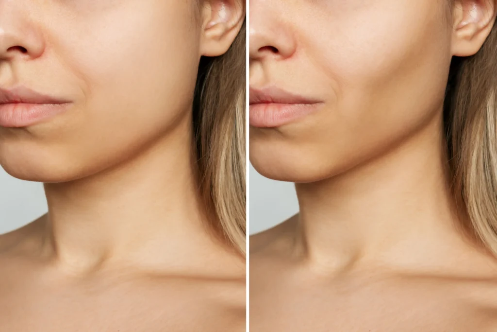 Left and right facial profile comparison showing visible differences in cheek contour and nasolabial fold appearance.
